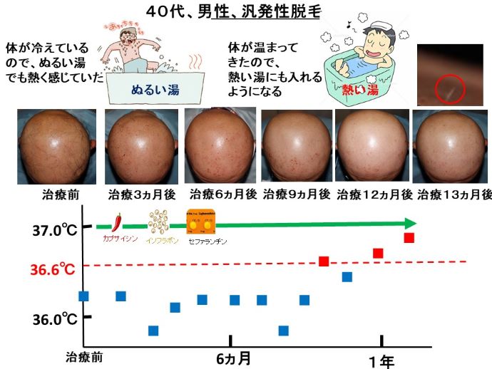 円形脱毛症　病院